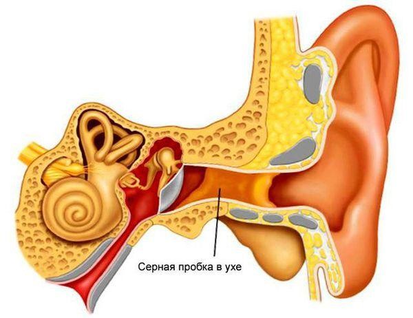 ​Как удалить серную пробку из уха