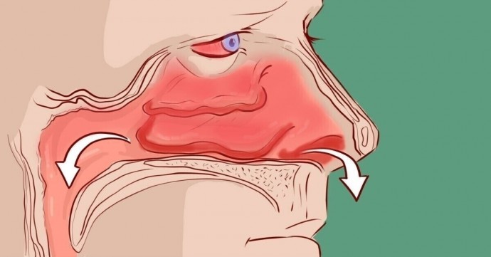 ​Заложенный нос при отсутствии насморка: почему так происходит