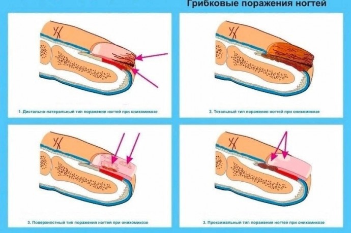 ​Лечим грибок на ногтях