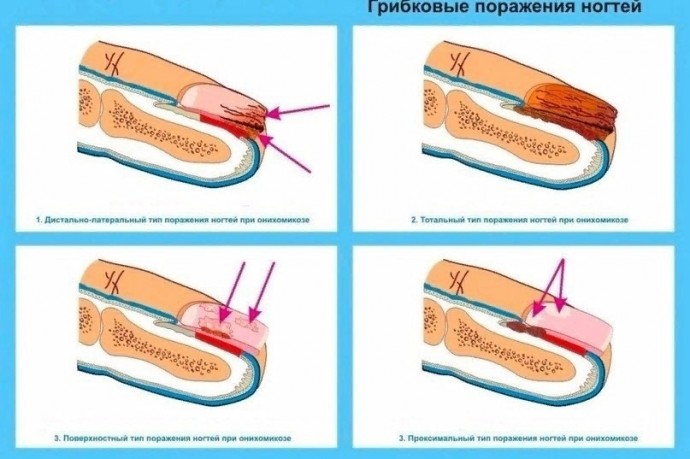 ​Лечение грибка ногтей