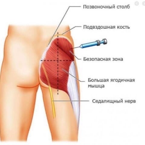 ​Правильно делать инъекции должен уметь каждый